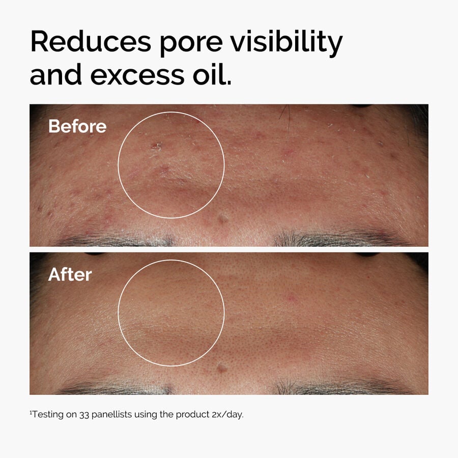 niacinamide-10-zinc-1-u1 ord-niacinamide-zinc-blemish-serum-before-after-pores.jpg