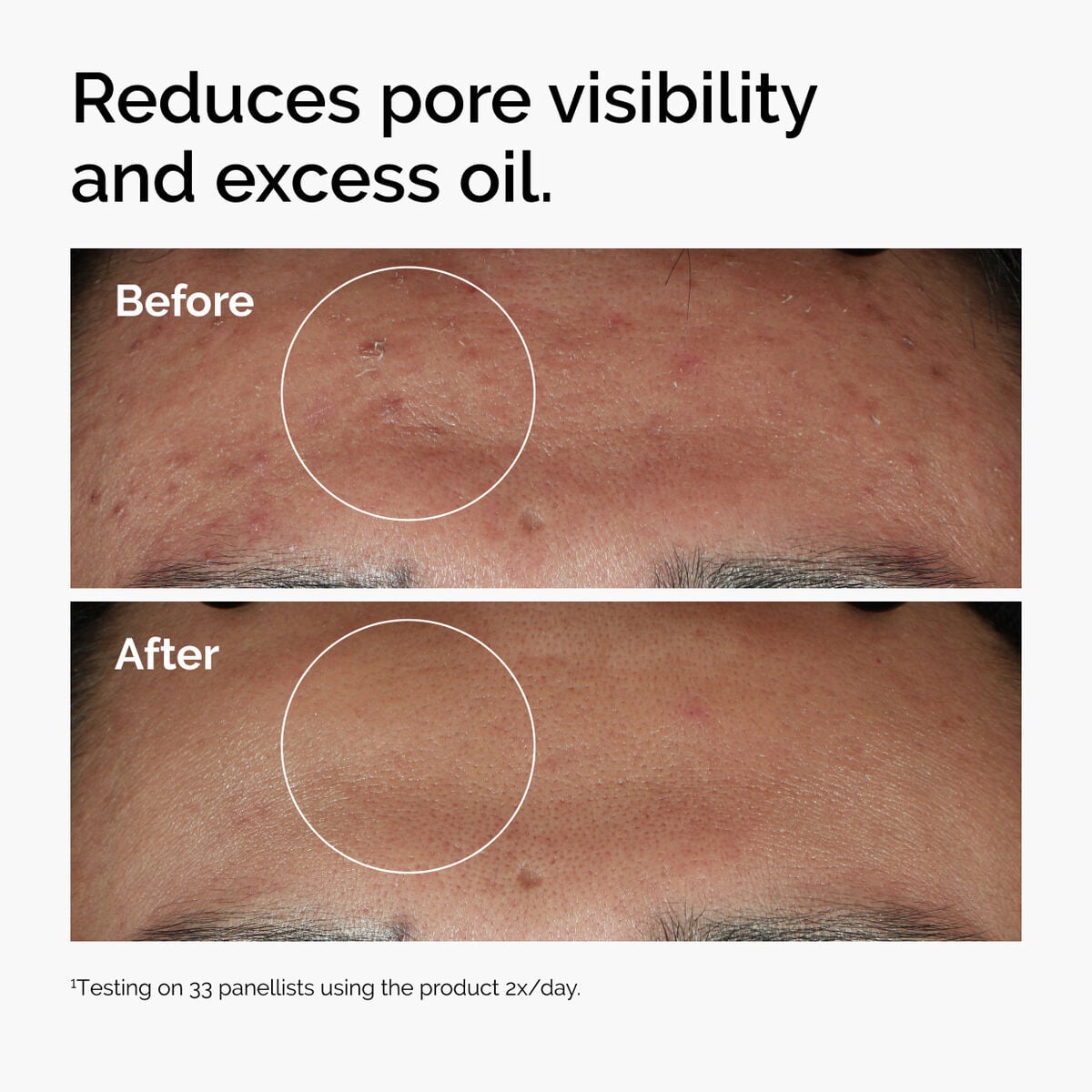 niacinamide-10-zinc-1-u1 ord-niacinamide-zinc-blemish-serum-before-after-pores.jpg