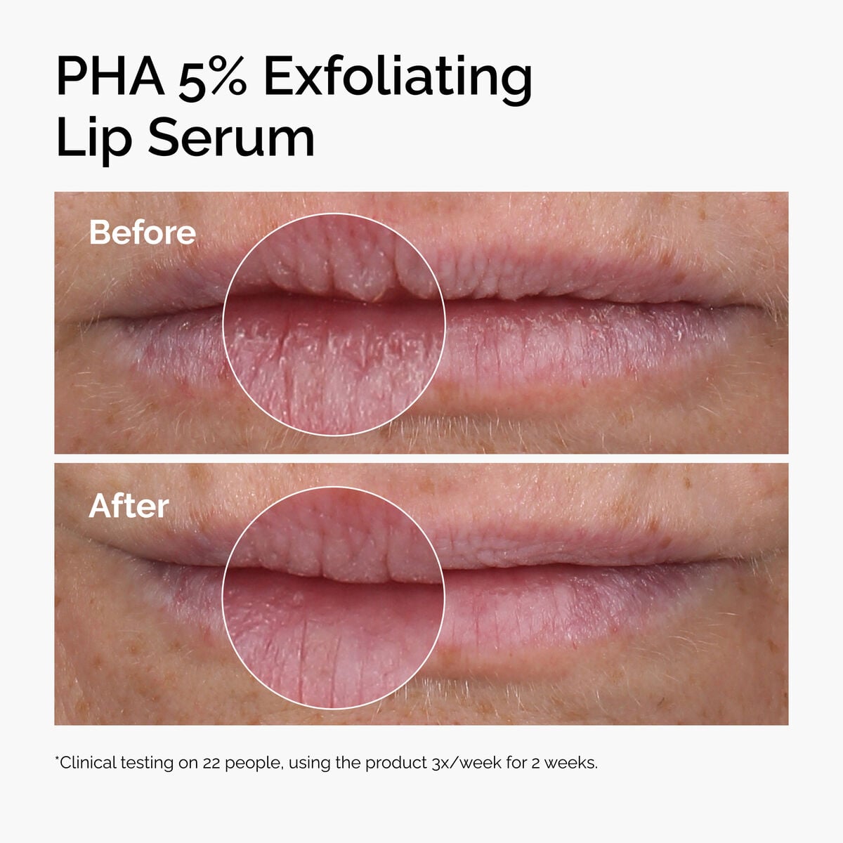 pha-5-exfoliating-lip-serum-u8 ord-pha-5pct-lip-exfoliating-serum-before-after.jpg