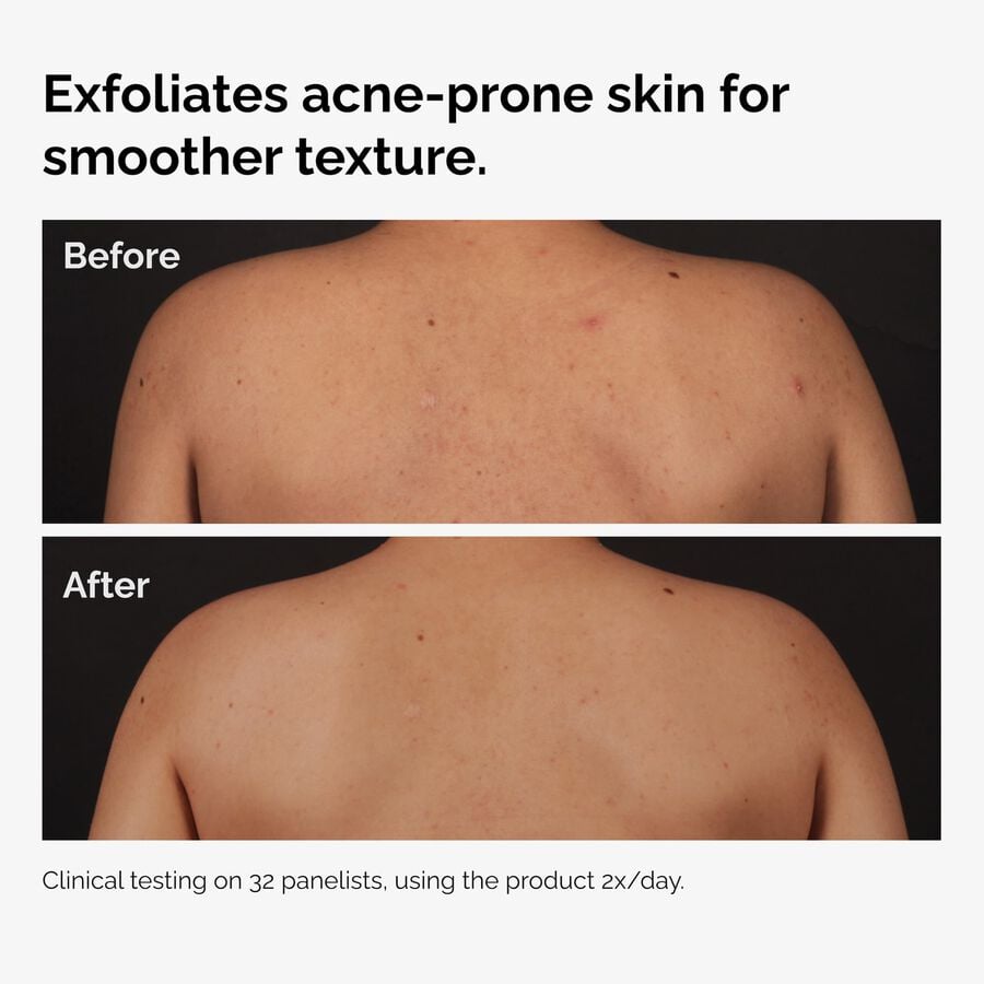 the-body-care-collection-u7 ord-salicylic-acid-body-serum-before-after-graphic-NA.jpg