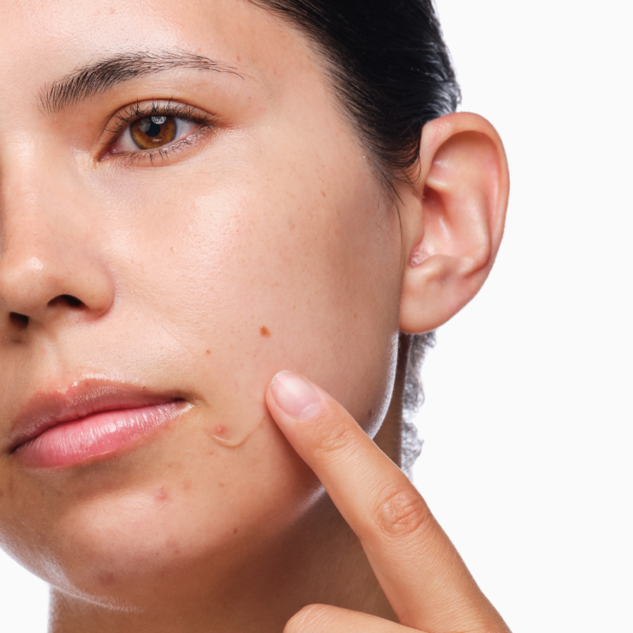 the-acne-set-t2 rdn-the-acne-set-application.png